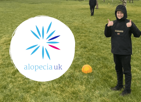 Dylan Johnson raises £385 for Alopecia Charity
